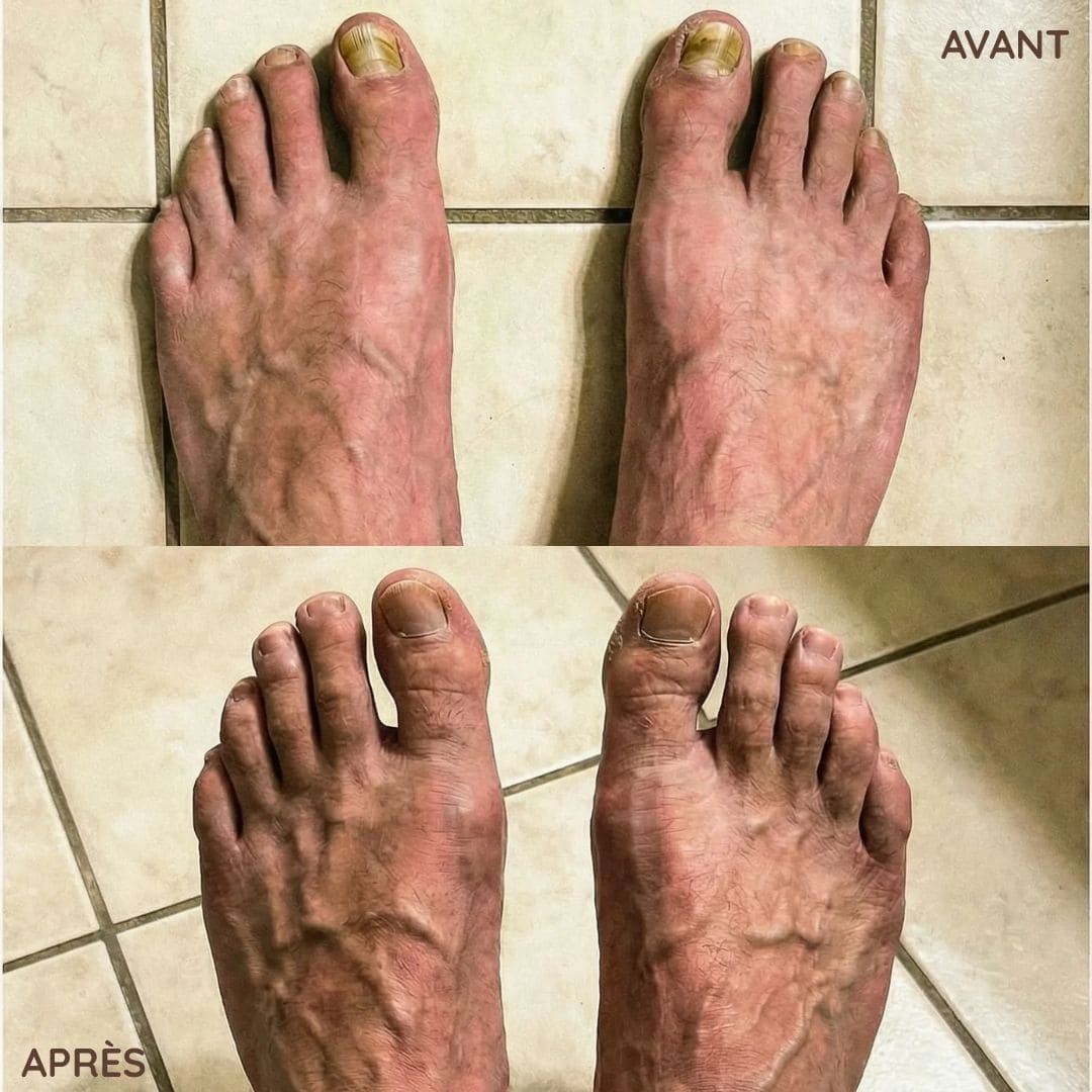 Crème antifongique pour les ongles