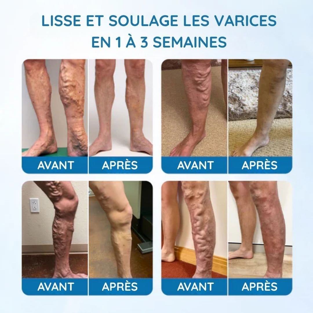 Spray réducteur de varices - Améliore la circulation sanguine