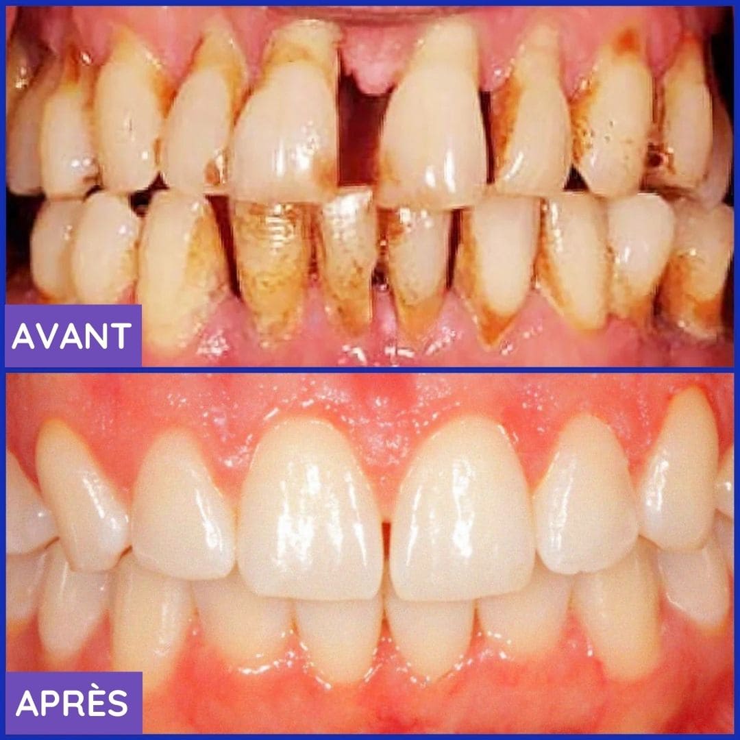 Dentifrice Blanchissant 3-en-1