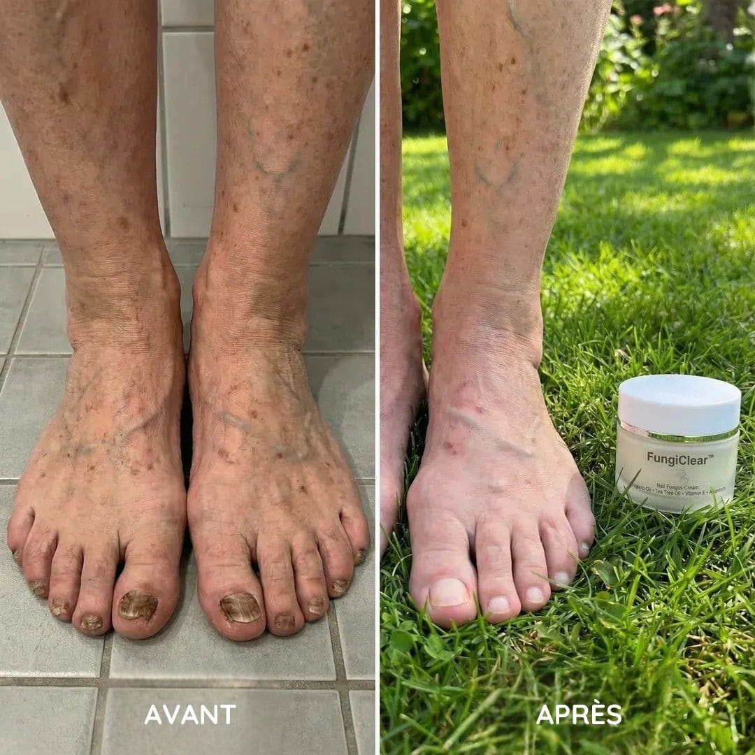 Crème antifongique pour les ongles