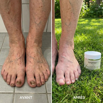 Crème antifongique pour les ongles