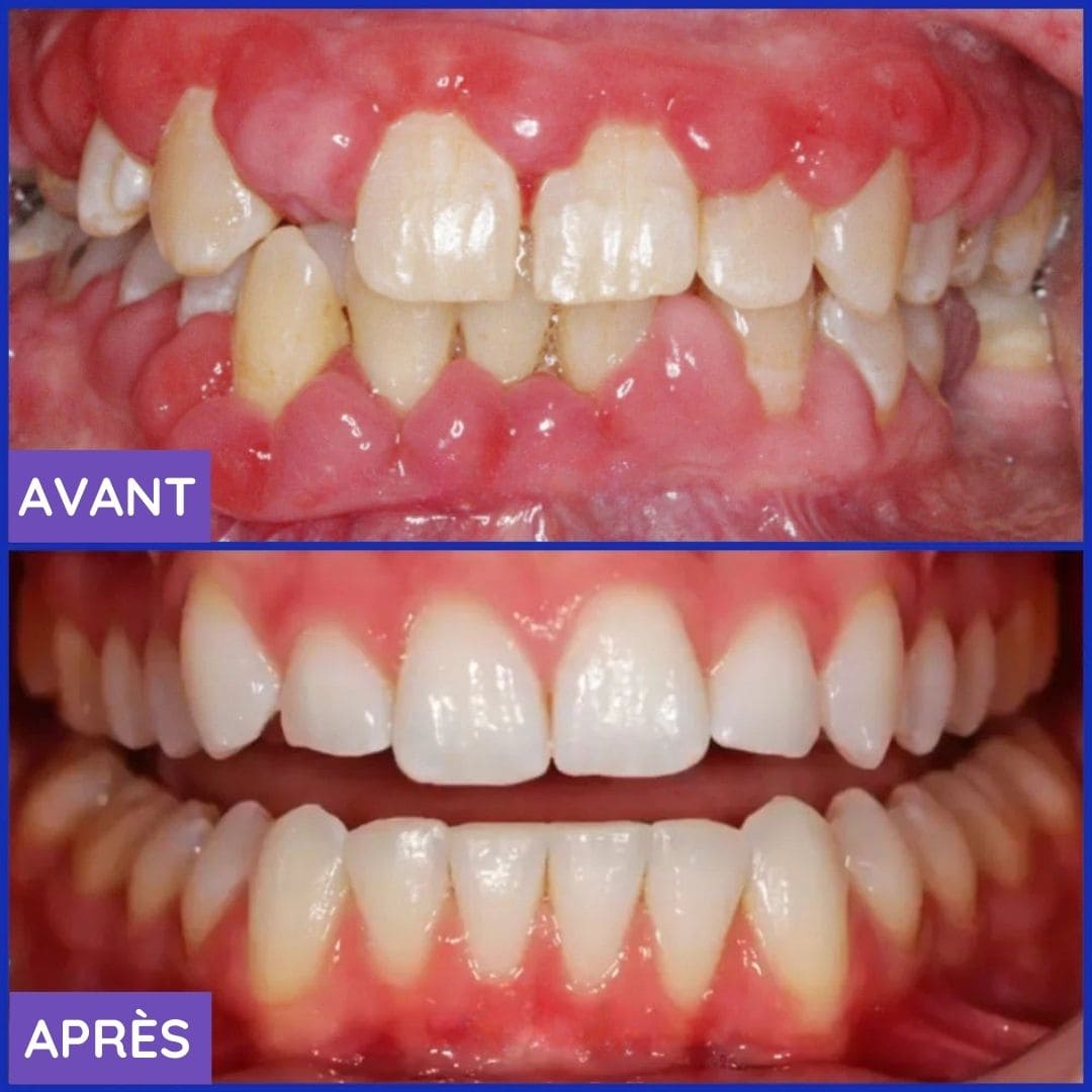 Dentifrice Blanchissant 3-en-1
