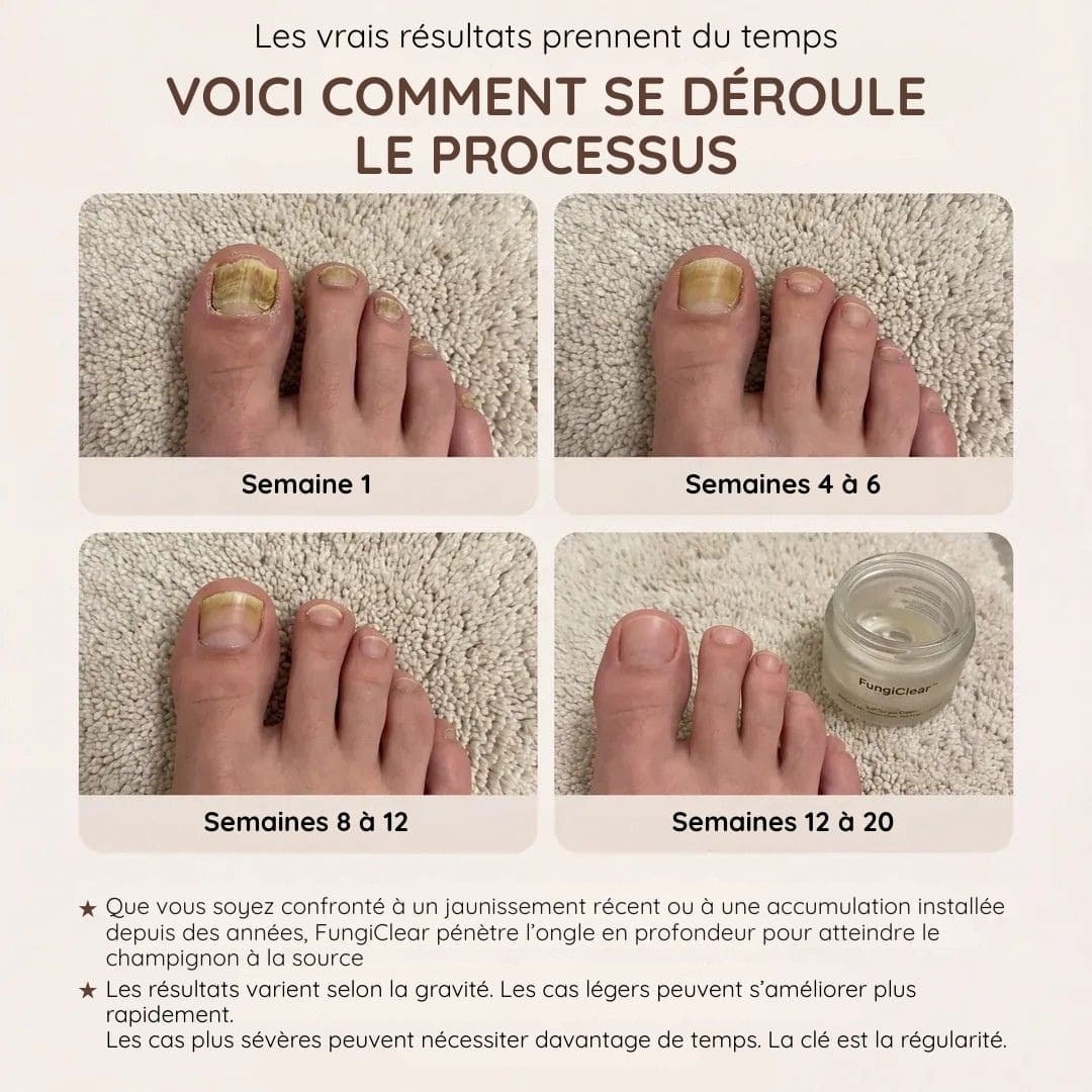 Crème antifongique pour les ongles