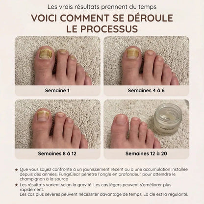 Crème antifongique pour les ongles