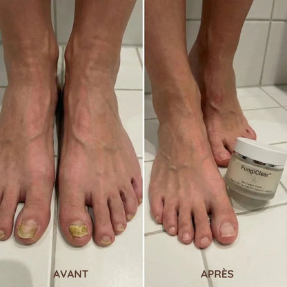 Crème antifongique pour les ongles