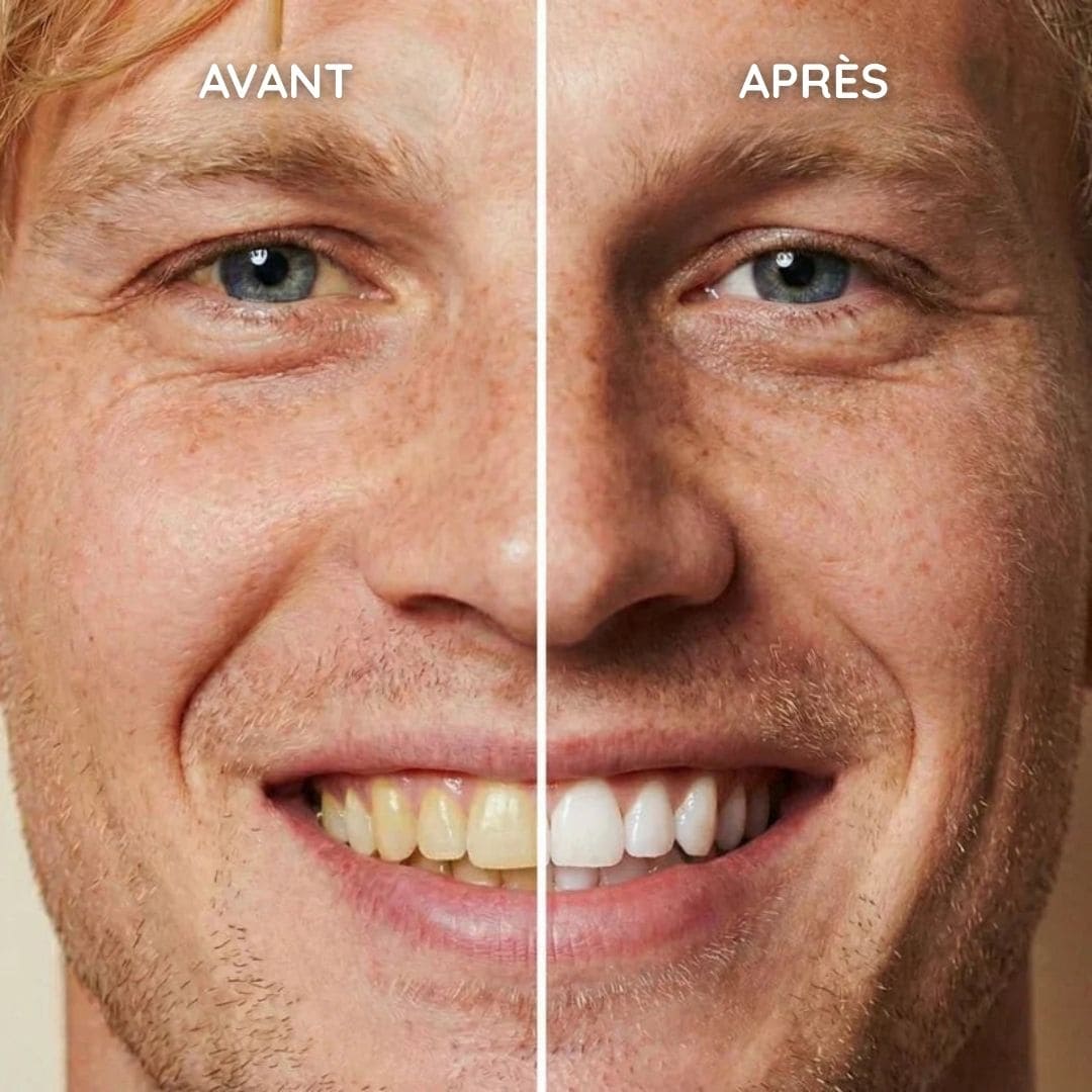 Vernis de blanchiment dentaire