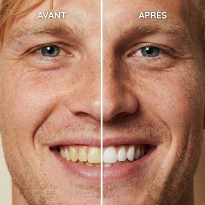 Vernis de blanchiment dentaire