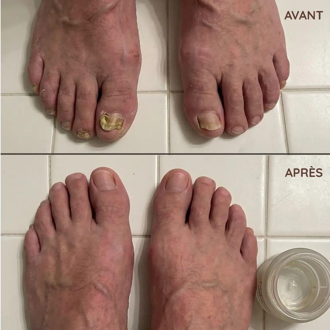 Crème antifongique pour les ongles