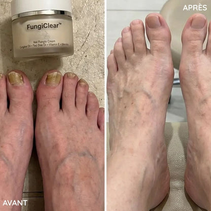 Crème antifongique pour les ongles