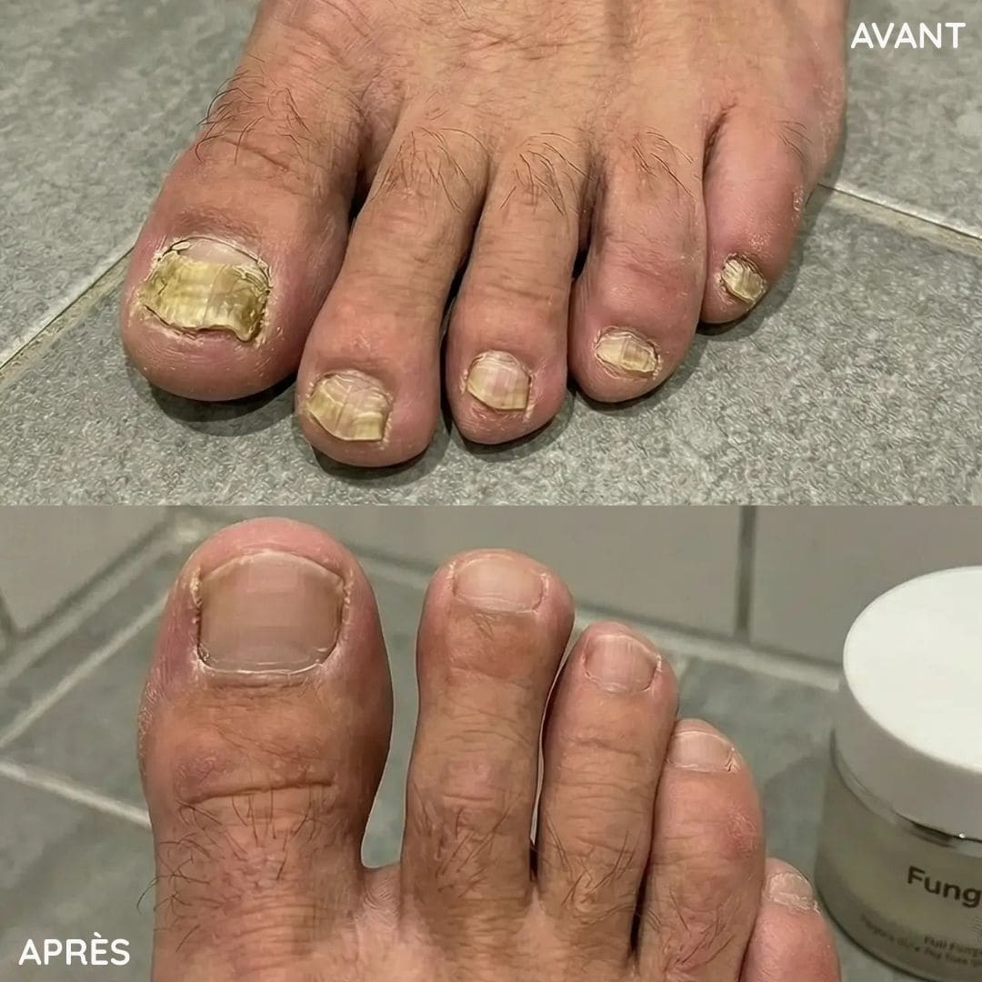 Crème antifongique pour les ongles