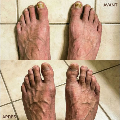 Crème antifongique pour les ongles