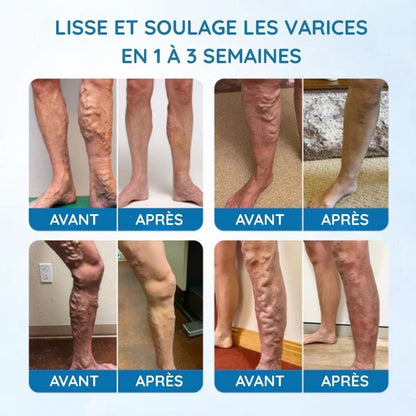 Spray réducteur de varices - Améliore la circulation sanguine